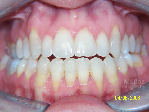 After image