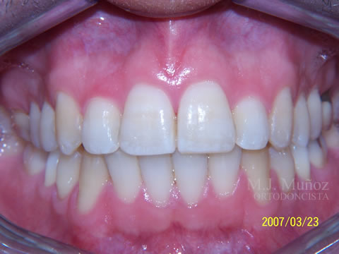 After image