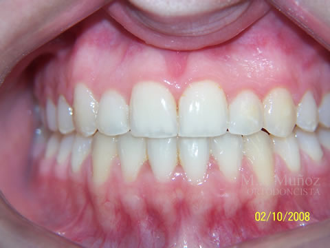 After image