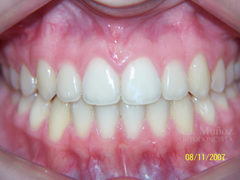 After image