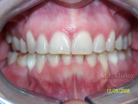 After image