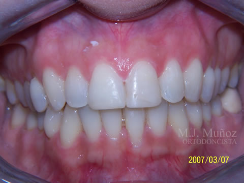 After image