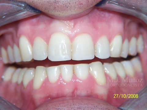 After image