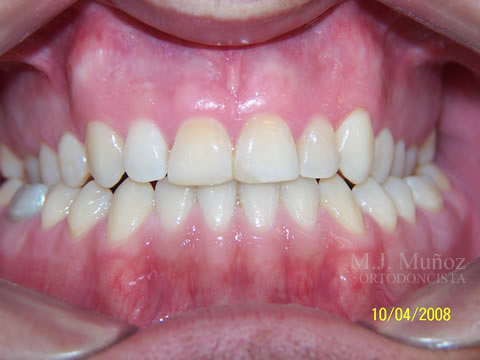 After image