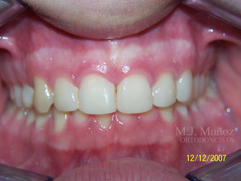 After image