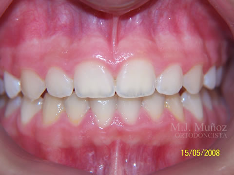 After image