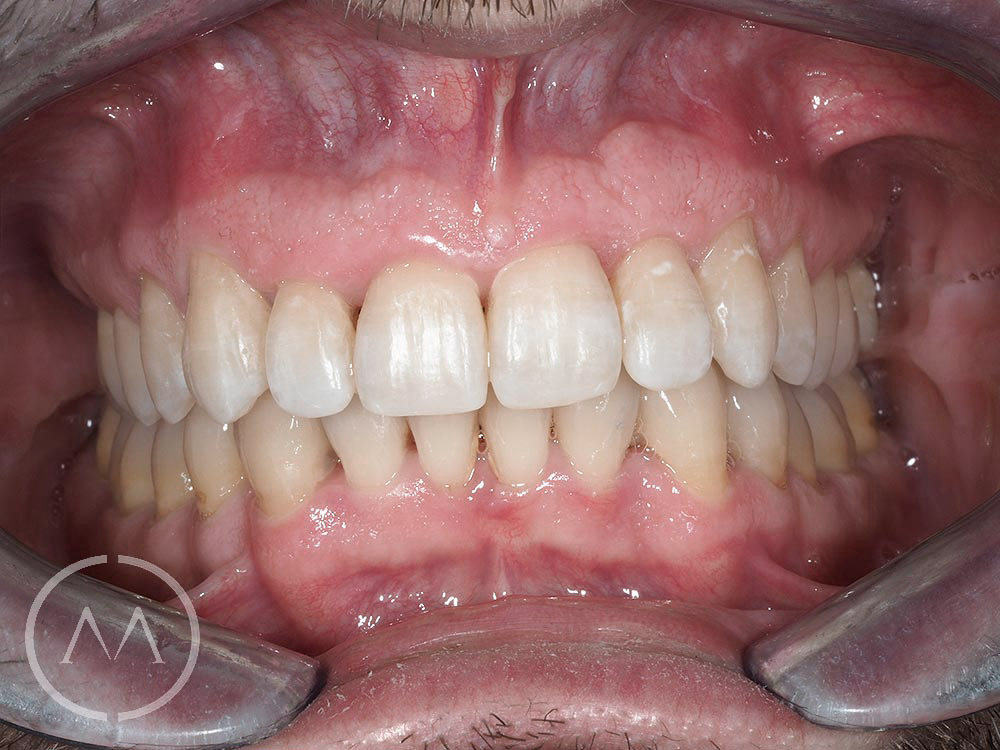 After image