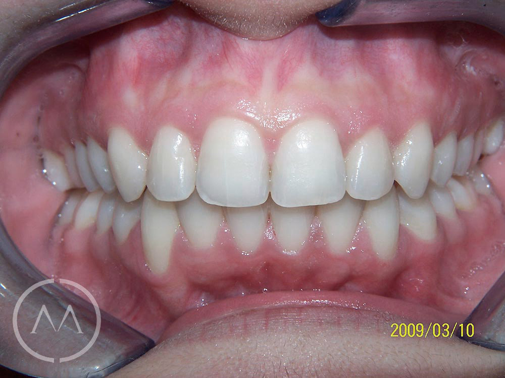 After image
