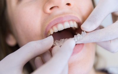 CONSEJOS PARA LIMPIAR LA ORTODONCIA INVISIBLE INVISALIGN CORRECTAMENTE