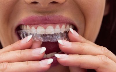 Beneficios de llevar ortodoncia invisalign
