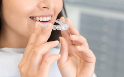 Guía completa para el cuidado y mantenimiento de tus alineadores Invisalign