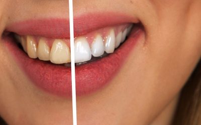Te explicamos el tratamiento de blanqueamiento dental