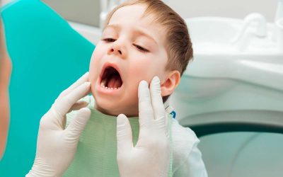 Candidiasis Bucal: Síntomas, Causas y Tratamiento.