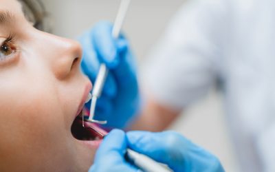 ¿Cómo detectar la caries dental?