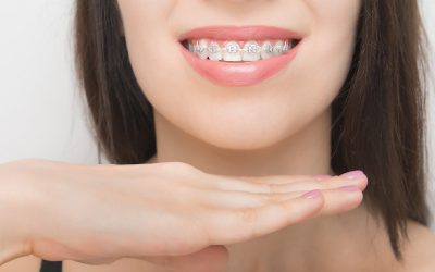 ¿Cuánto tiempo hay que llevar los Brackets?