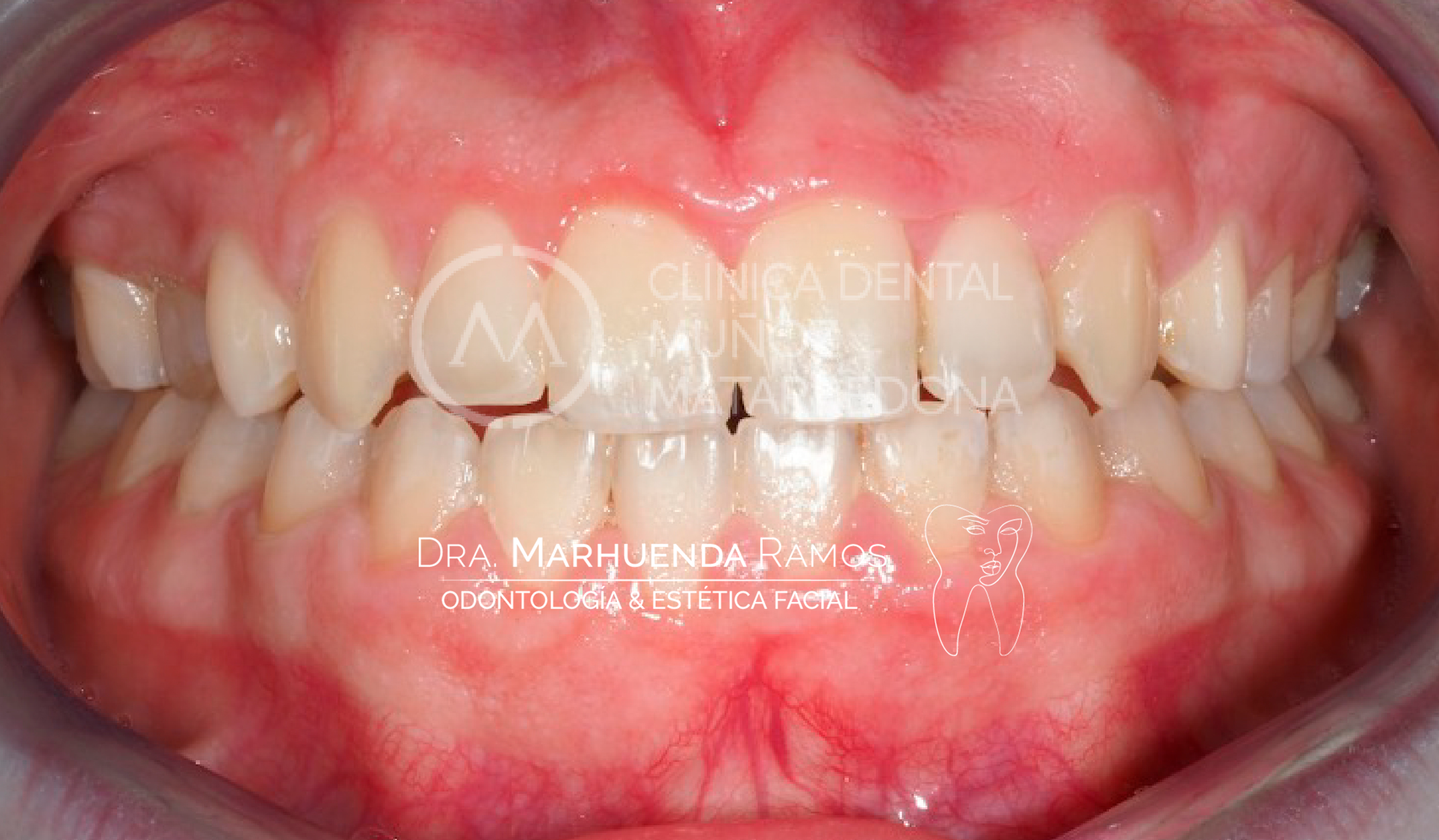 After image