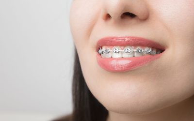 ¿Puedo utilizar ortodoncia si llevo implantes?
